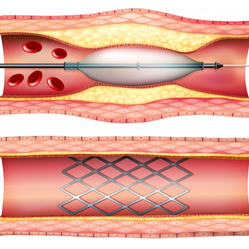 Cirurgia Endovascular