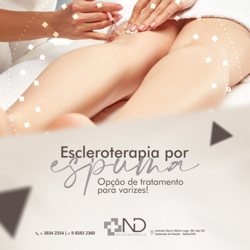 Escleroterapia por espuma