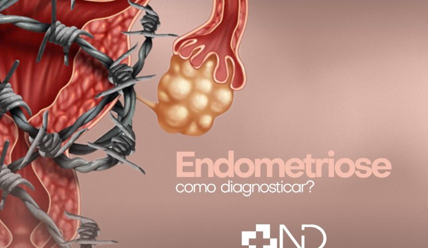 Endometriose como diagnosticar?